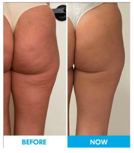 Before and After Endospheres Therapy